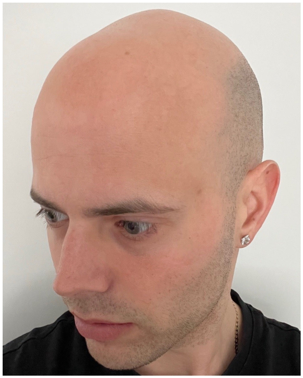 Exploring the Causes of Male Baldness.