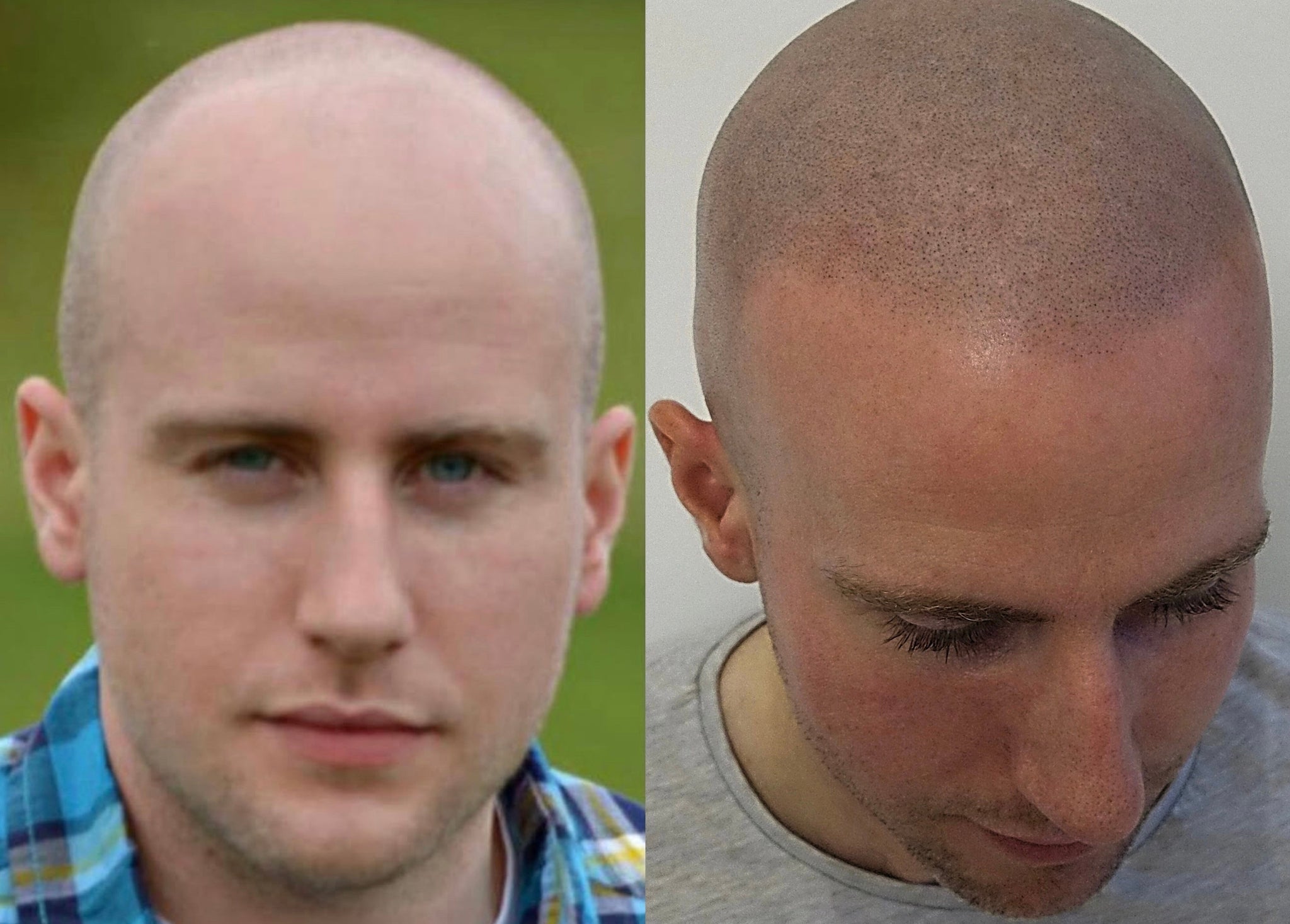 SMP Hairline Tattoo is about not feeling bald anymore