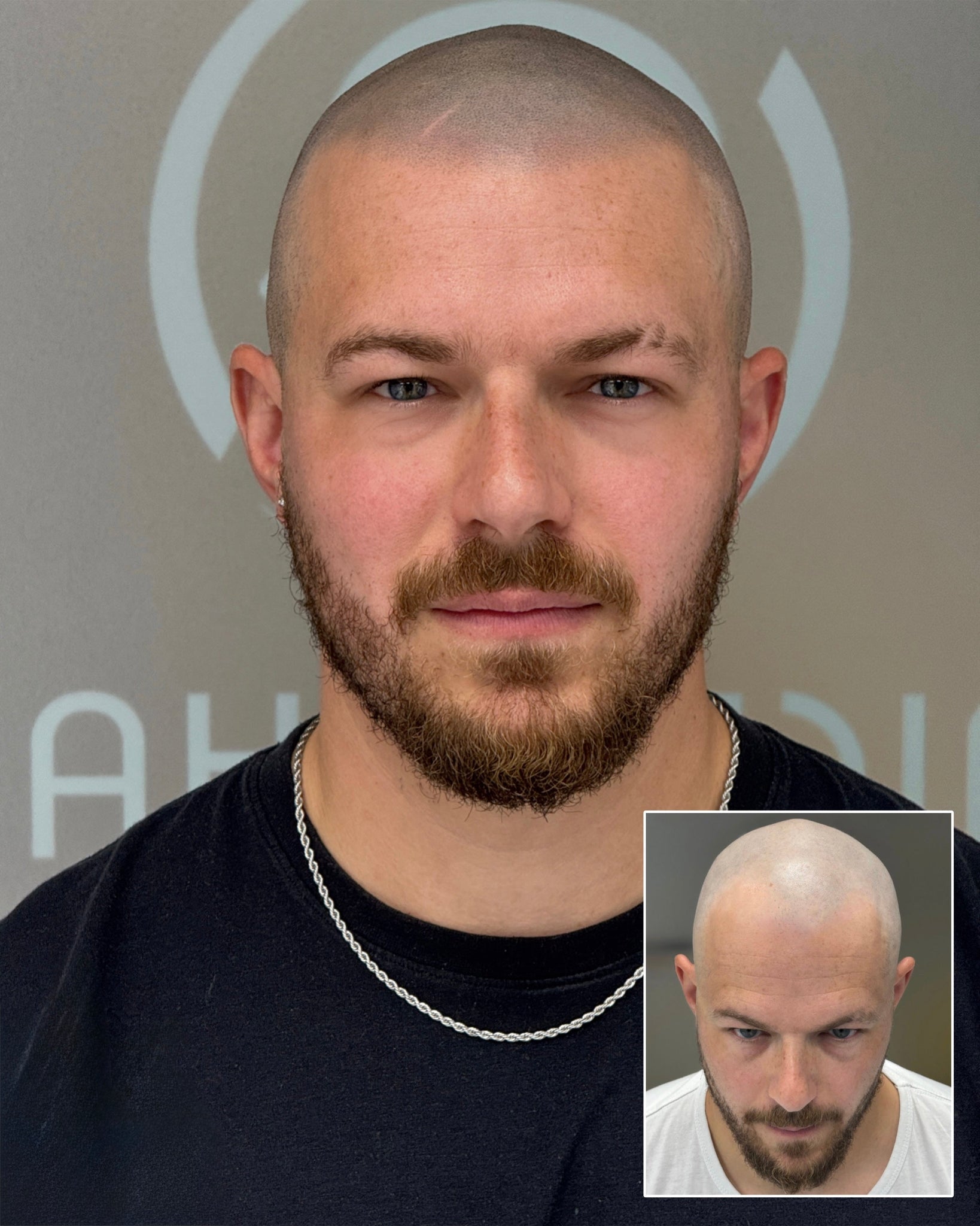  SMP Liverpool SMP Manchester hair tattoo Liverpool hairline pigmentation smp manchester scalp micropigmentation hairline pigmentation