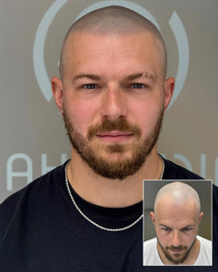  SMP Liverpool SMP Manchester hair tattoo Liverpool hairline pigmentation smp manchester scalp micropigmentation hairline pigmentation