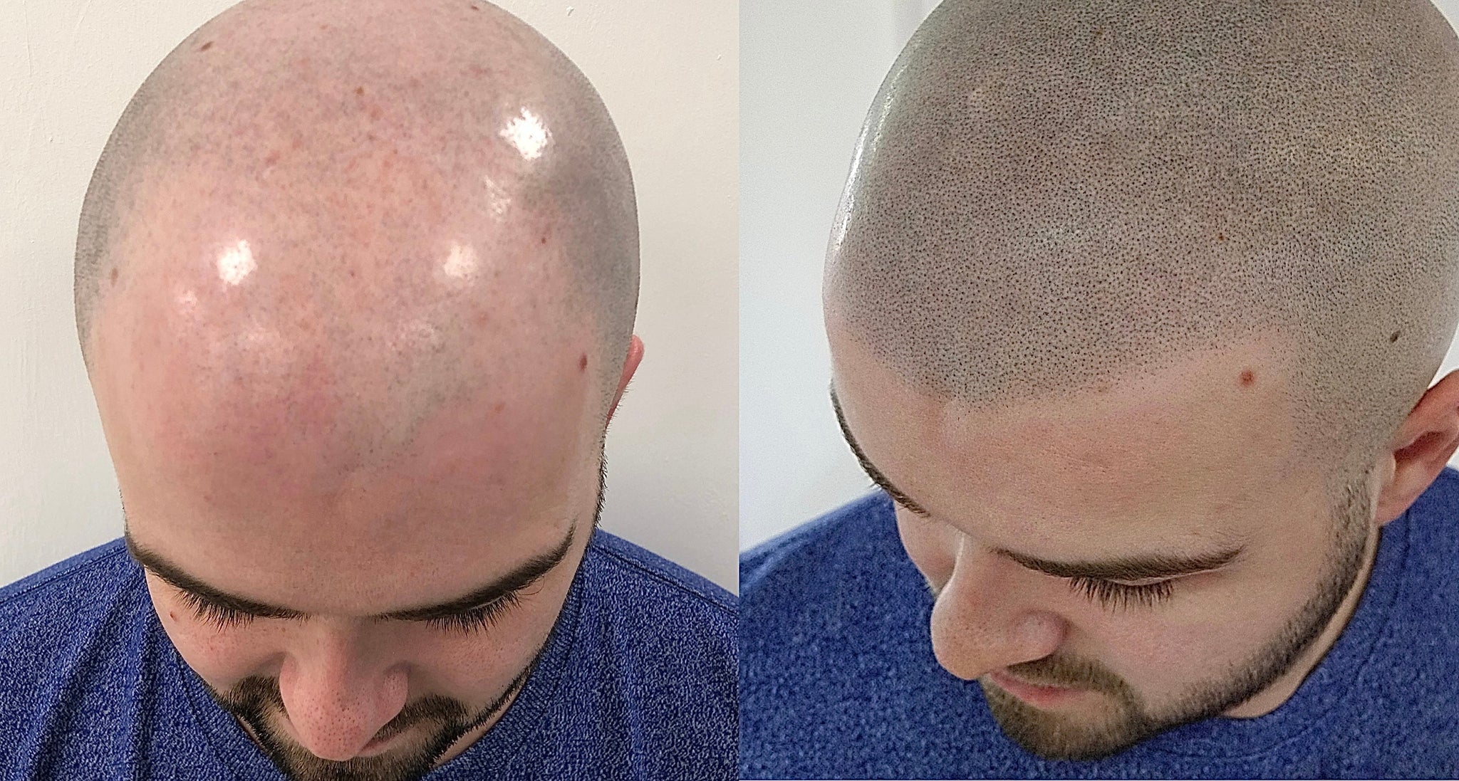 Is SMP Hair Tattoo Expensive? A Closer Look at the Real Value