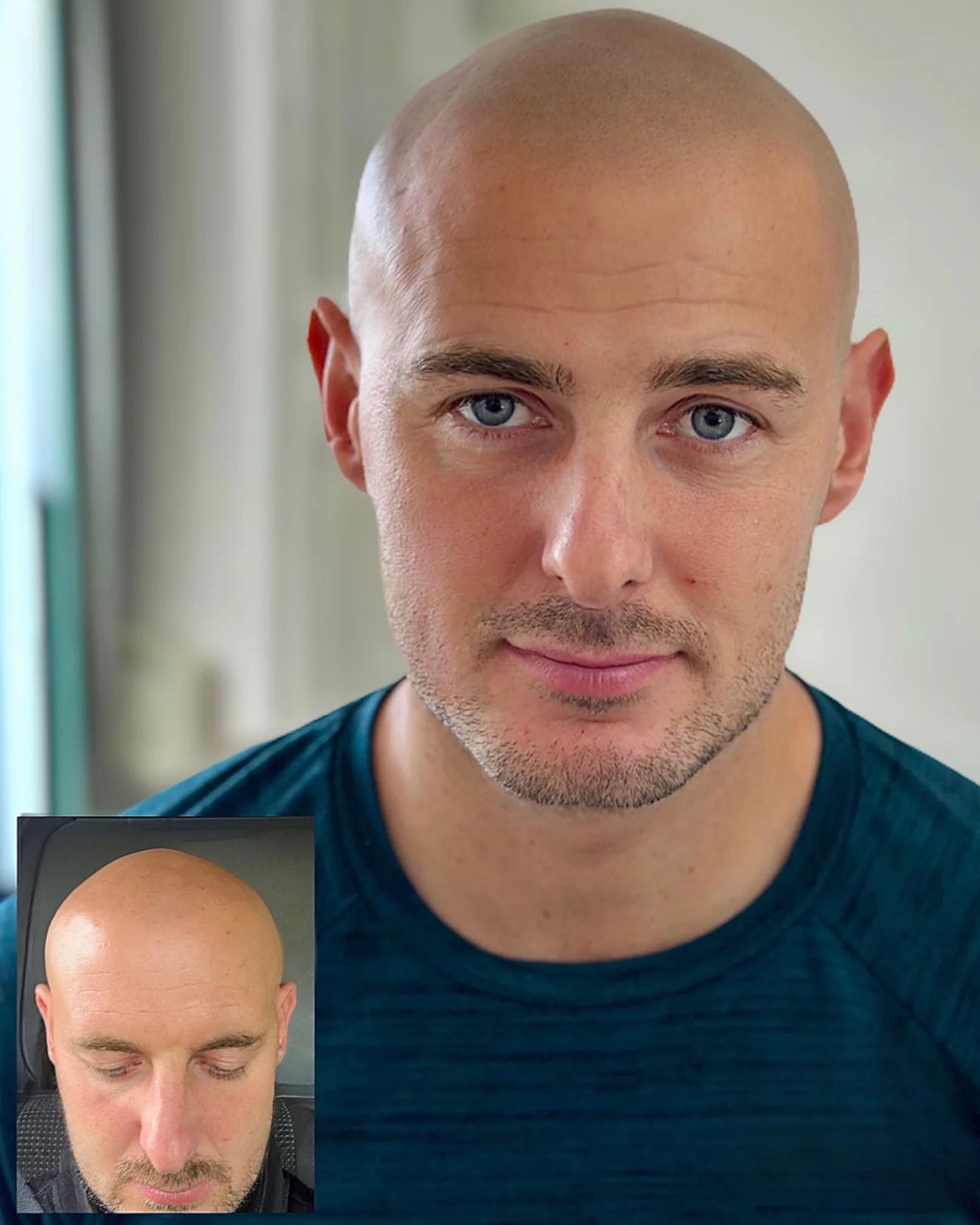 Discover a New You with Scalp Micropigmentation (SMP) in Manchester