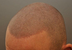 Why You Shouldn’t Trust Unsettled Scalp Micropigmentation Results