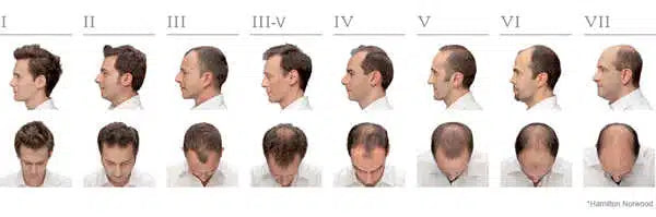 Understanding the Norwood Stages of Male Pattern Baldness.