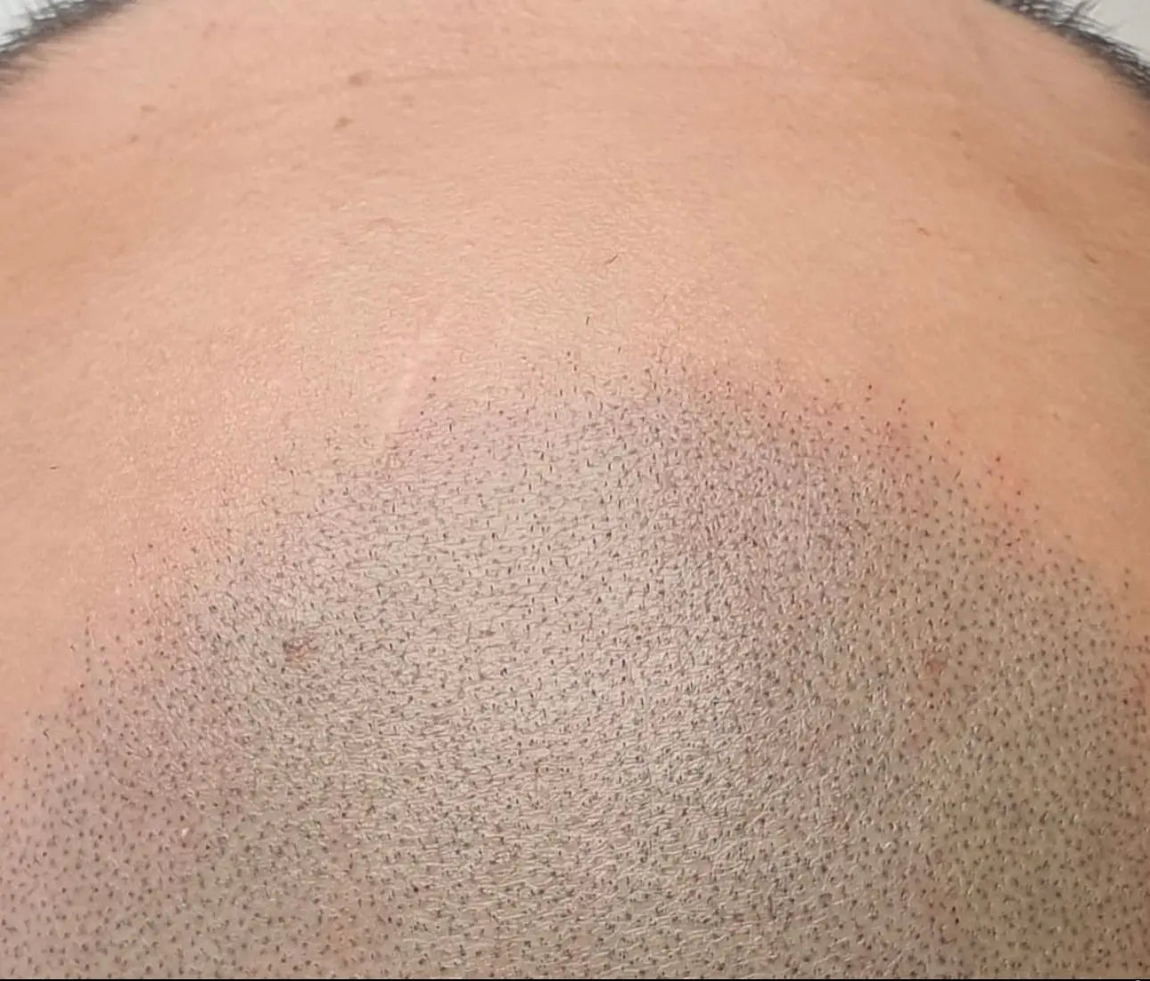  SMP Liverpool SMP Manchester hair tattoo Liverpool hairline pigmentation smp manchester scalp micropigmentation hairline pigmentation