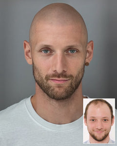 Scalp Micropigmentation Liverpool – Client Reviews of MicroHair® And Marcin Adam