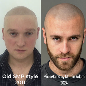 The Evolution of SMP: From Straight Hairlines to Natural Perfection