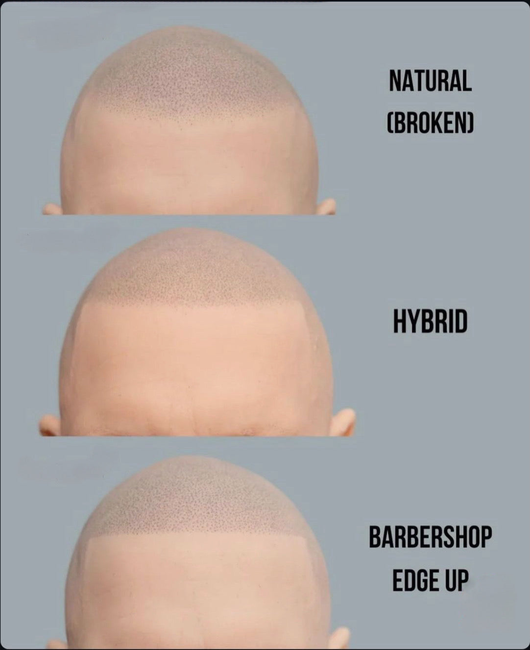 Understanding Hairlines in Scalp Micropigmentation: Natural, Hybrid, and Barbershop Edge-Up